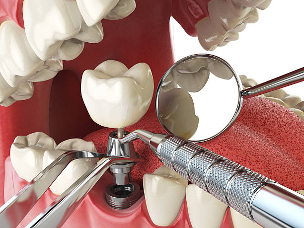 Best Emergency Dental Surgery in Blacksburg, VA